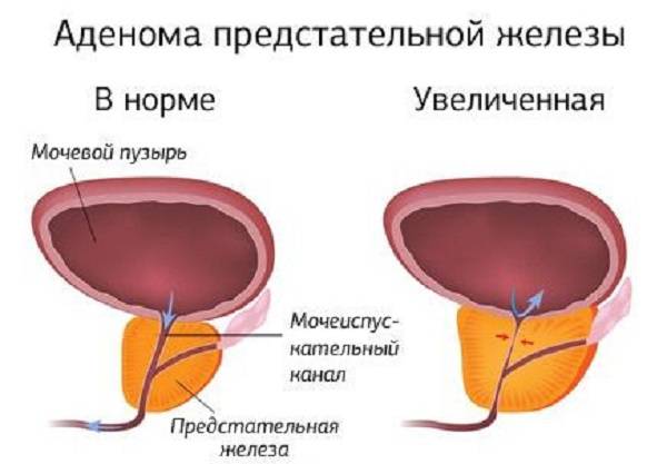 Как лечить аденомы простаты в домашних условиях Как лечить аденомы простаты в домашних условиях