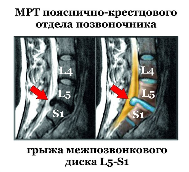 Как лечат грыжу пояснично крестового отдела Как лечат грыжу пояснично крестового отдела