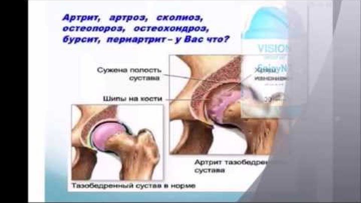 Артроз коленного сустава лечение в домашних условиях народными