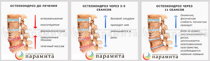 Поясничный остеохондроз что такое и как лечить Поясничный остеохондроз что такое и как лечить