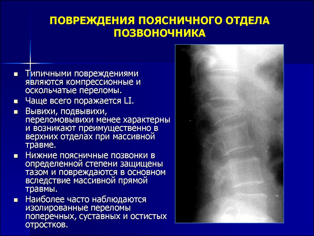 Лечение травм отделов позвоночника Лечение травм отделов позвоночника