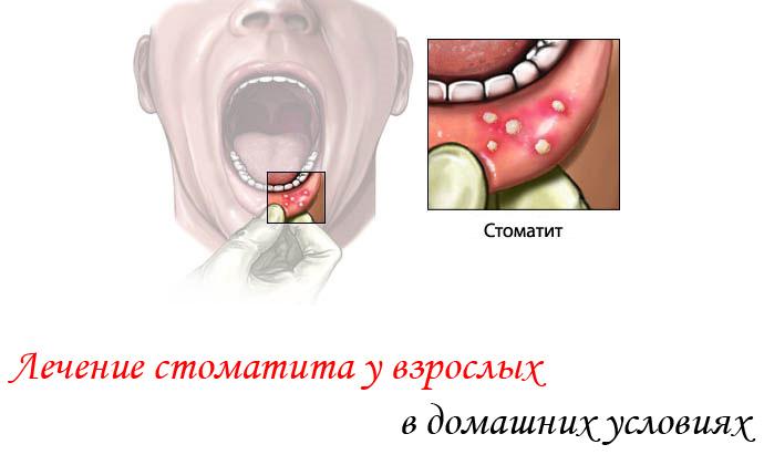 Как и чем лечить стоматит у ребенка в домашних условиях