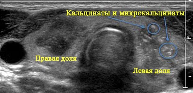 Структура простаты с кальцинатами Структура простаты с кальцинатами