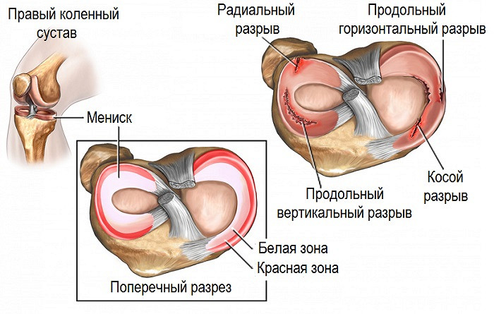 Как лечить воспаление мениска коленного сустава Как лечить воспаление мениска коленного сустава