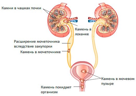 Что делать когда вышел камень из почки