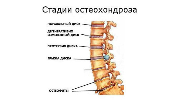 Степени остеохондроза шейного позвонка Степени остеохондроза шейного позвонка