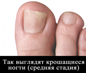 Крошатся ногти на ногах