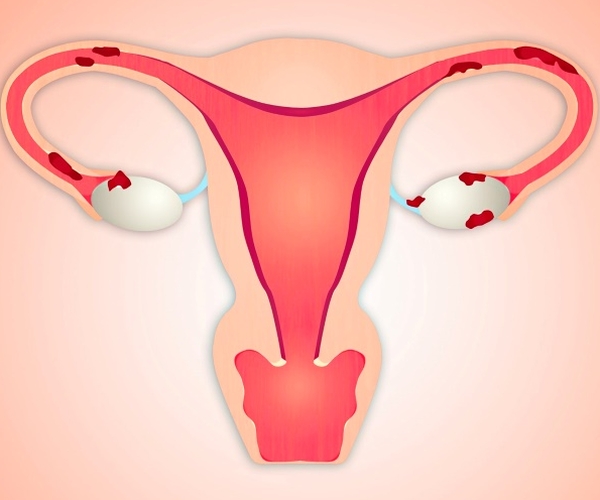 История болезни по гинекологии аденомиоз матки