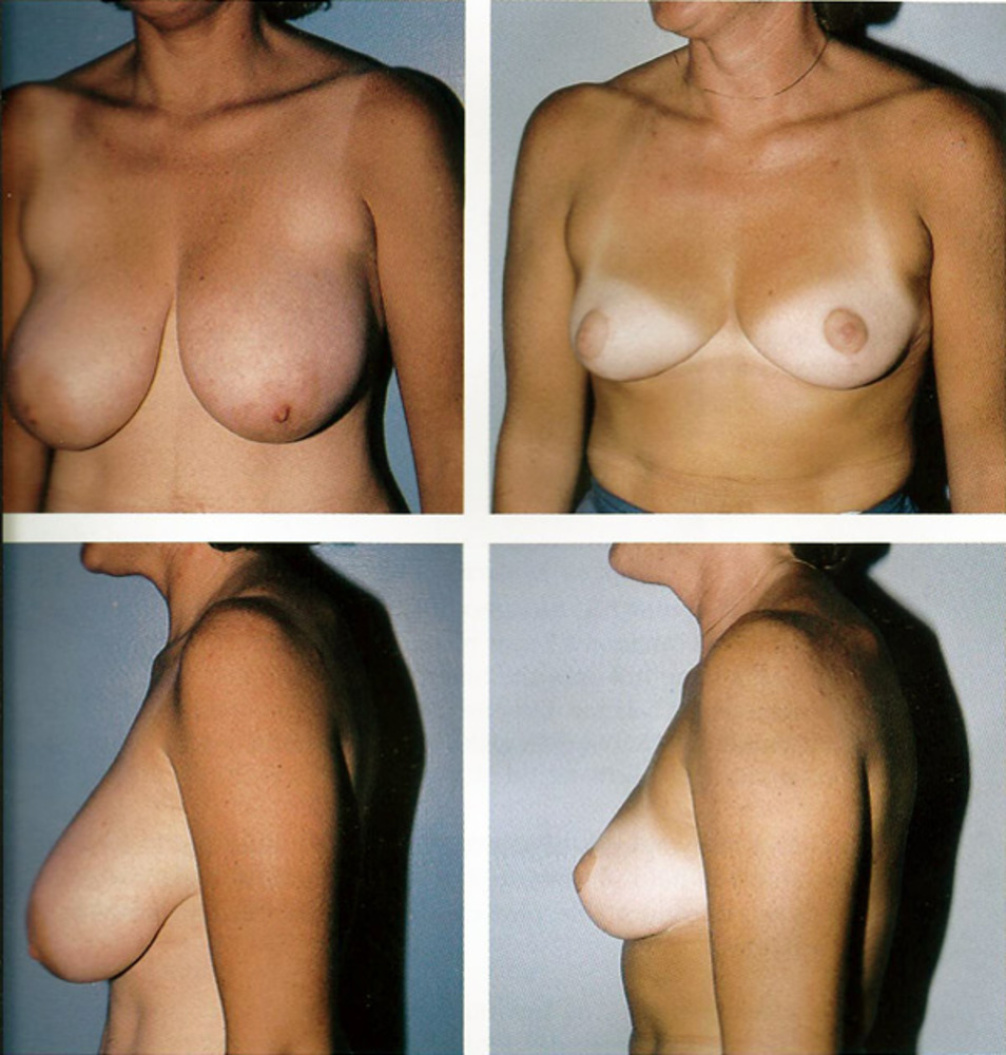 как восстановить одну грудь после кормления фото 103