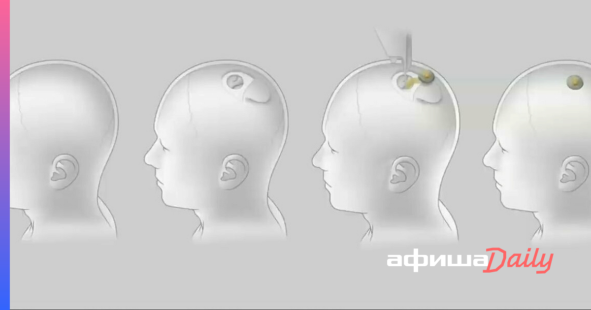 Подключения мозга к компьютеру имплант