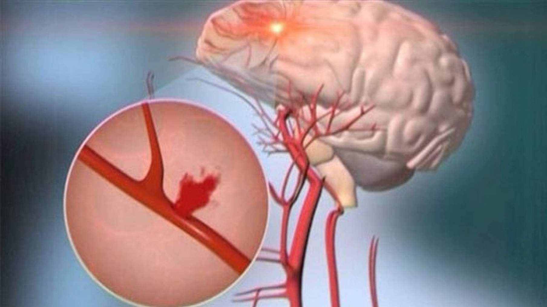 Кровотечение и кровоизлияние. Субарахноидальное кровоизлияние это инсульт. Геморрагический инсульт разрыв сосуда. Геморрагический субарахноидальный инсульт. Субарахноидальное кровоизлияние артерии.